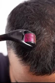 Derma Roller System 540 Titanyum İğneli 0.5 Mm thumbnail 5