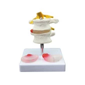 Lumbar Vertebra Disk Hernisi Omurga Modeli Model 4 thumbnail 1