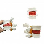 Disk Hernisi Fıtık Maketi Model 2 thumbnail 3