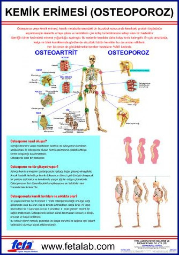Osteoporoz Eğitim Plakası (KEMİK ERİMESİ) ürün görseli 1