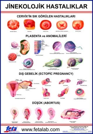 Jinekolojik Hastalıklar Eğitim Plakası ürün görseli 1