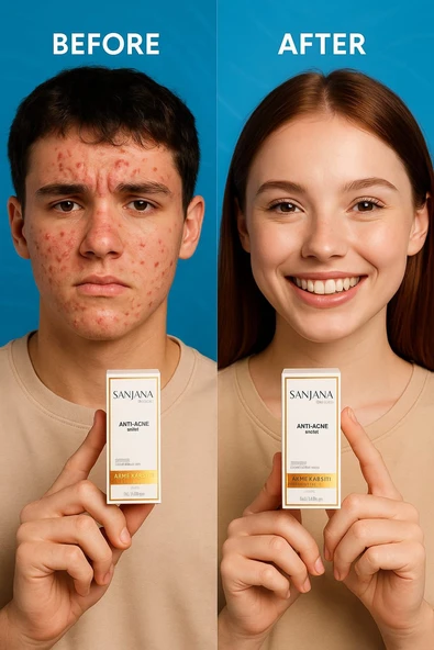 Sanjana Beauty Anti Acne Serum 10 ml , Akne Karşıtı, Sivilce Kurutucu, Cilt Arındırıcı Serum ürün görseli 1