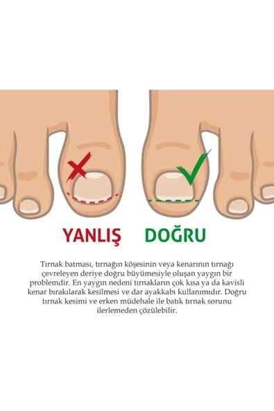 MİNTOLA STORE Ayak Tırnağı Düzeltme Bandı 10 adet ürün görseli 1
