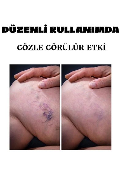 Süper Varicose Veins Var.is Kremi 100 ML - Resim 3
