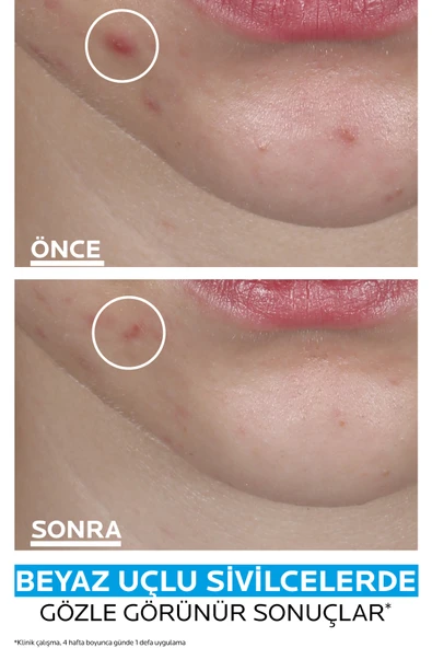 LA ROCHE POSAY La Roche-Posay Effaclar Duo+M Patch 22 Patch - Resim 3