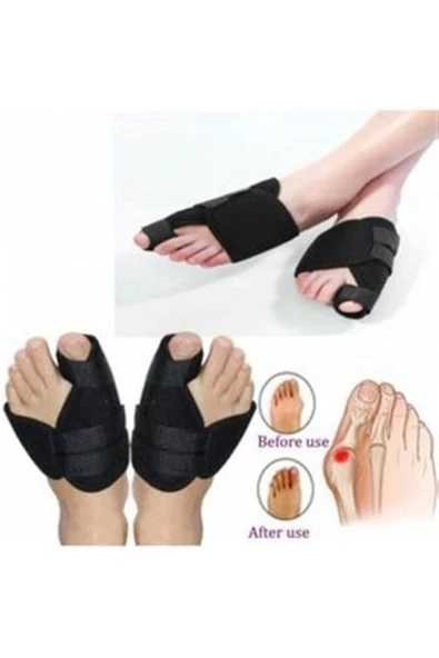 2 Adet Halluks Valgus Gece Ateli Ayak Baş Parmak Bunyon Tabanlık ürün görseli 1
