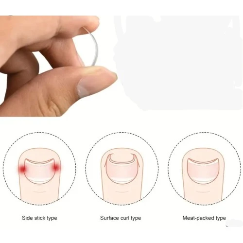 Batık Tırnak Düzeltici Aparat ürün görseli 1