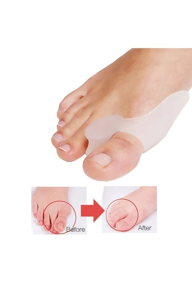 müge medikal Aveo 2 Adet Silikon Makaralı Bunyon Hallux Valgus (kemik Çıkıntısı) Sprinti Çekiç Parmak Düzeltici ürün görseli 1