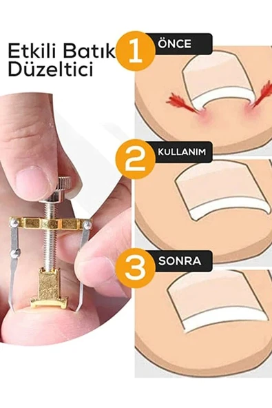 Batık Tırnak Çıkartıcı Orijinal Çelik Batan Tırnağı Düzeltme Aparatı Düzeltici Aleti Çıkarıcı Aparat ürün görseli 1