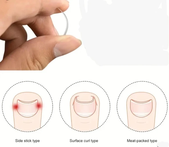 Mey İthalat® Ayak Tırnak Batmasını Önleyen Metal Aparat – Sağlıklı ve Konforlu Çözüm ürün görseli 1