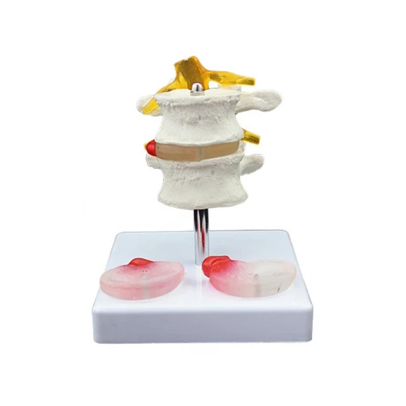 Lumbar Vertebra Disk Hernisi Omurga Modeli Model 4 ürün görseli 1