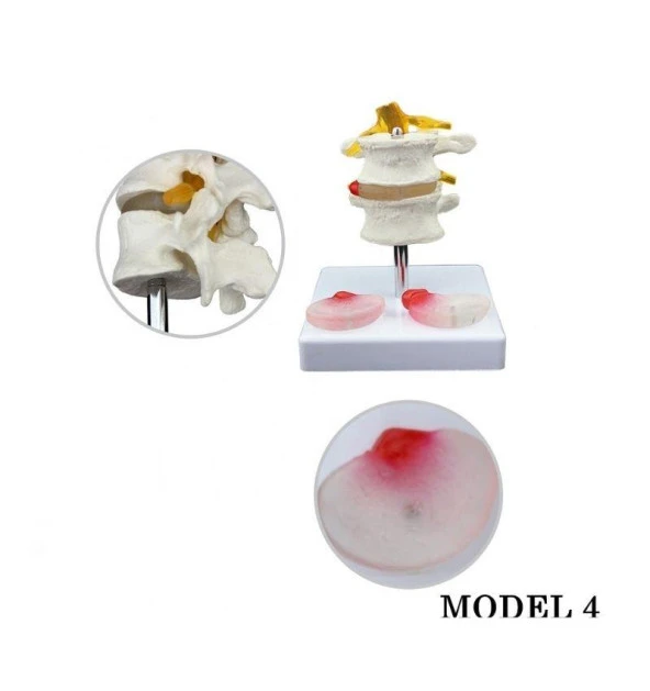 Lumbar Vertebra Disk Hernisi Omurga Modeli Model 4 - Resim 2