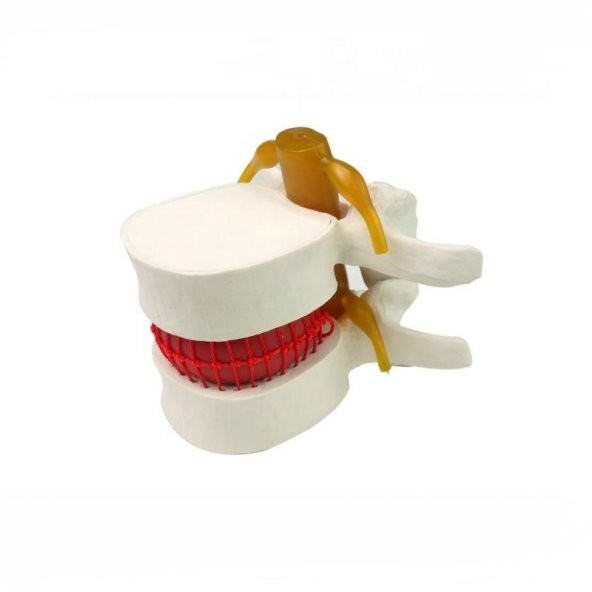 Disk Hernisi Fıtık Maketi Model 2 - Resim 2
