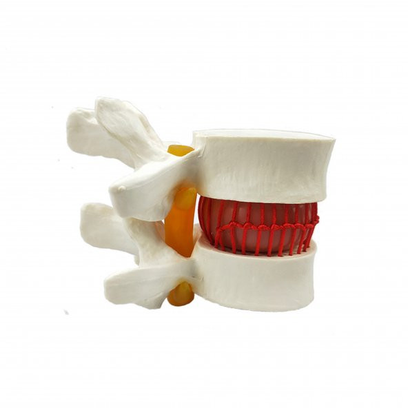 Disk Hernisi Fıtık Maketi Model 2 - Resim 4