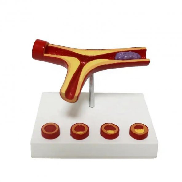 Damar Tıkanıklığı Model 46 - Resim 3