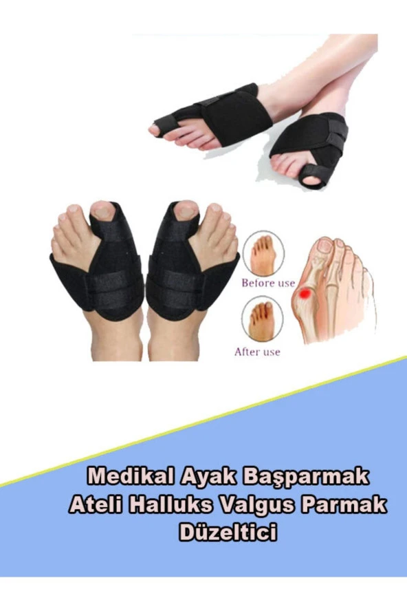 Ortopedik Halluks Valgus Ayak Başparmak Ateli Ayak Başparmak Kemik Düzeltici Atel 2 Li Set ürün görseli 1