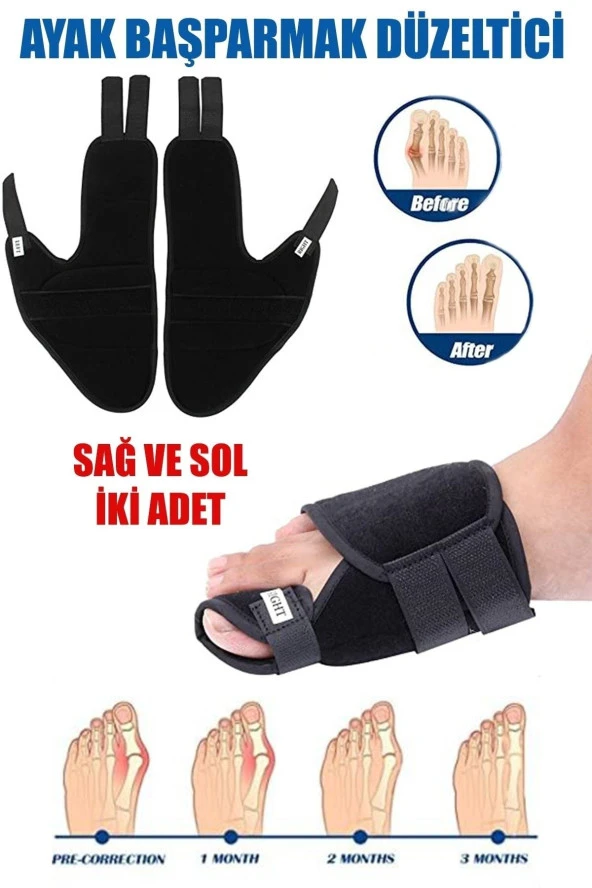 Ayak Başparmak Kemiği Çıkıntısı Bunyonu Düzeltici Halluks Valgus Ayak Sağlığı Ateli 1 Çift ürün görseli 1