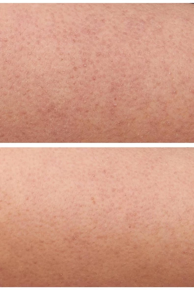 StriVectin KP Care Cilt Bakım Seti 2 Parça - Resim 4